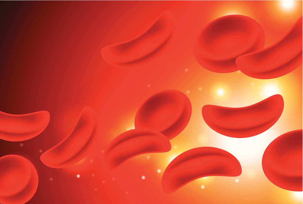 What Is Sickle Cell Anemia? | YourCareEverywhere