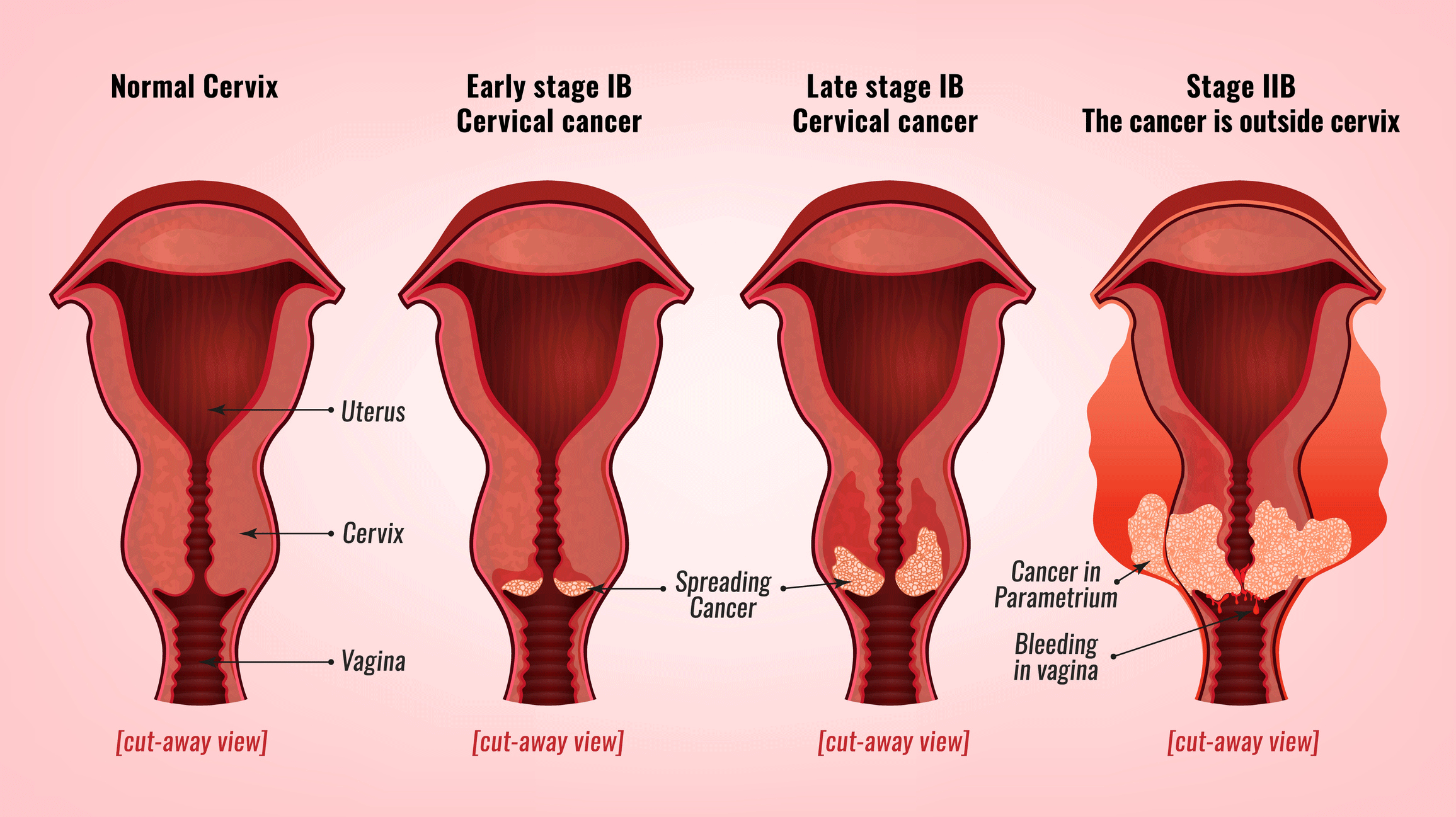 Cervical vaginal cancer