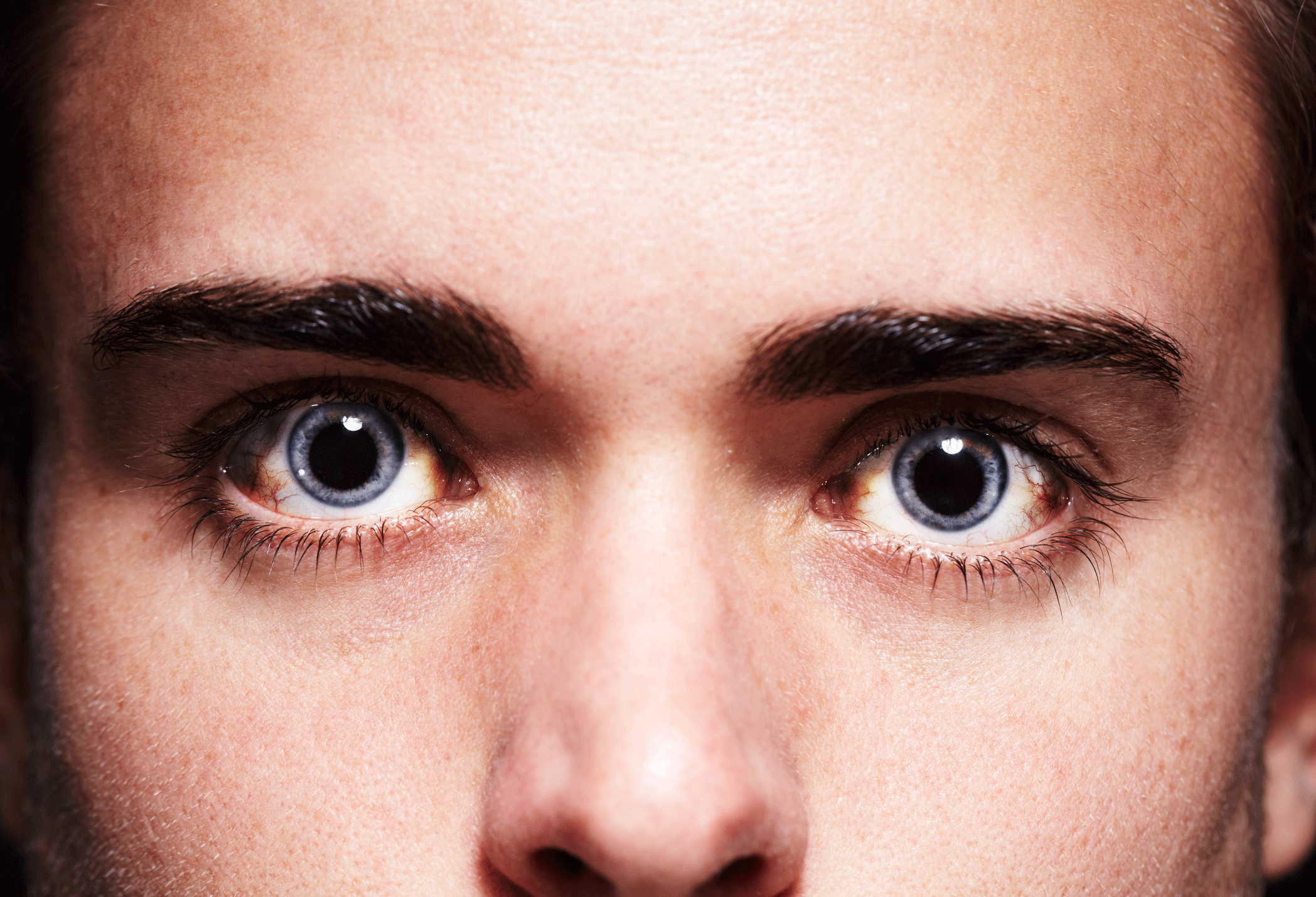 Mydriasis Causes And Treatment For Dilated Pupils