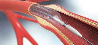 What Is Coronary Artery Disease?