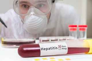 A vial of blood contaminated with hepatitis A