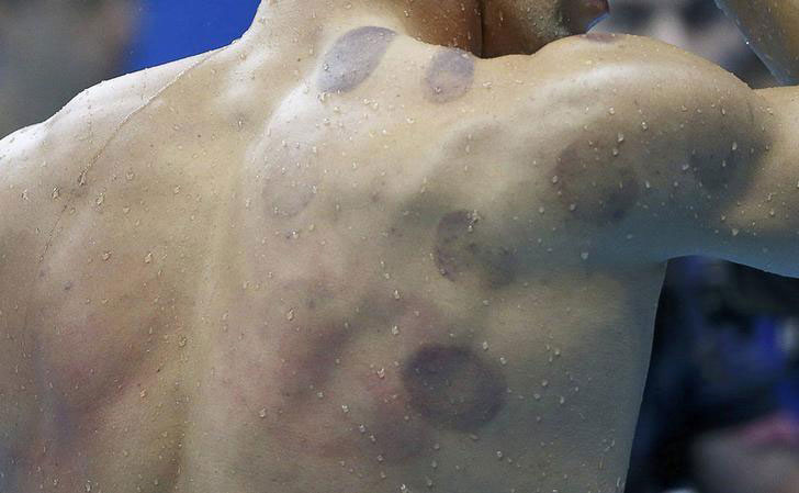 Can Cupping Help with Muscle Pain?