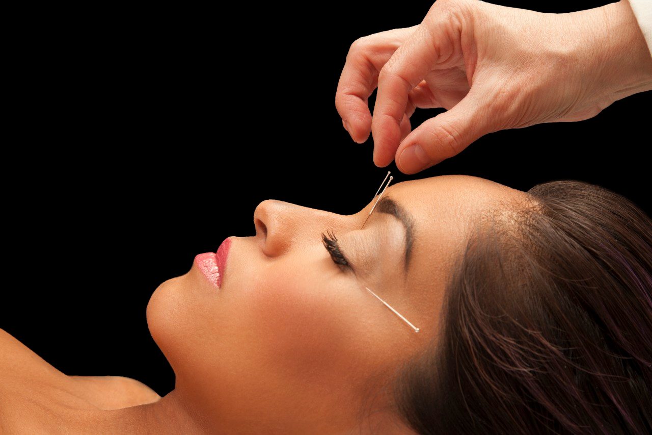 What Is Acupuncture? What Is Acupuncture?