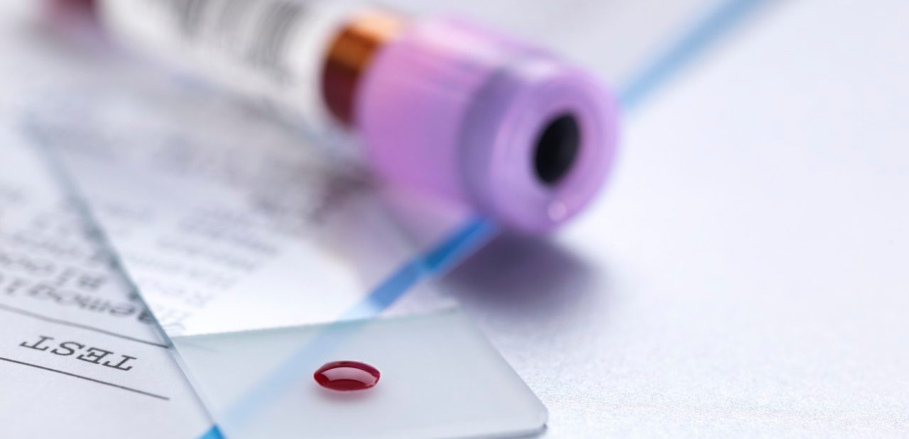 Blood sample on microscope slide with vial and results of the blood test. --- Image by © Andrew Brookes/Corbis