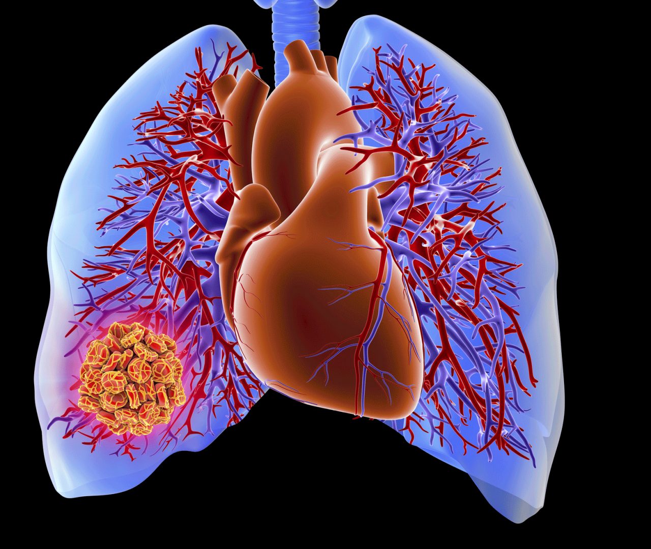 Pulmonary Embolism Symptoms