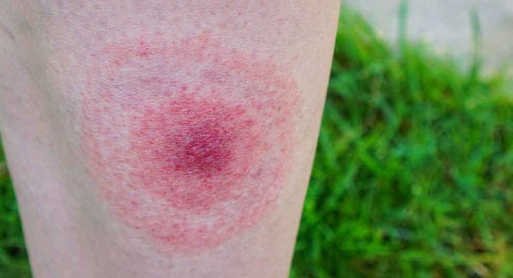 Symptoms of Lyme Disease