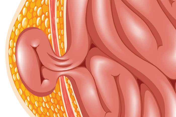 What Is a Hernia?