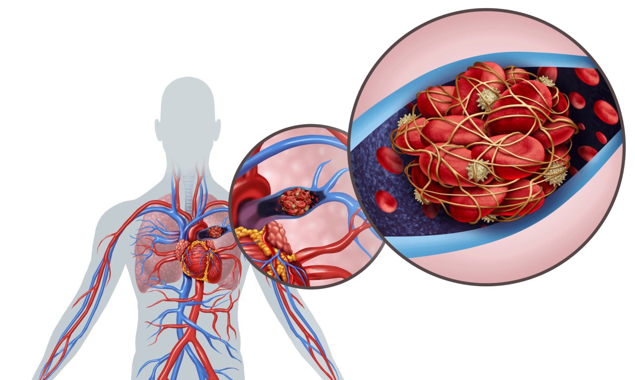 Pulmonary embolism