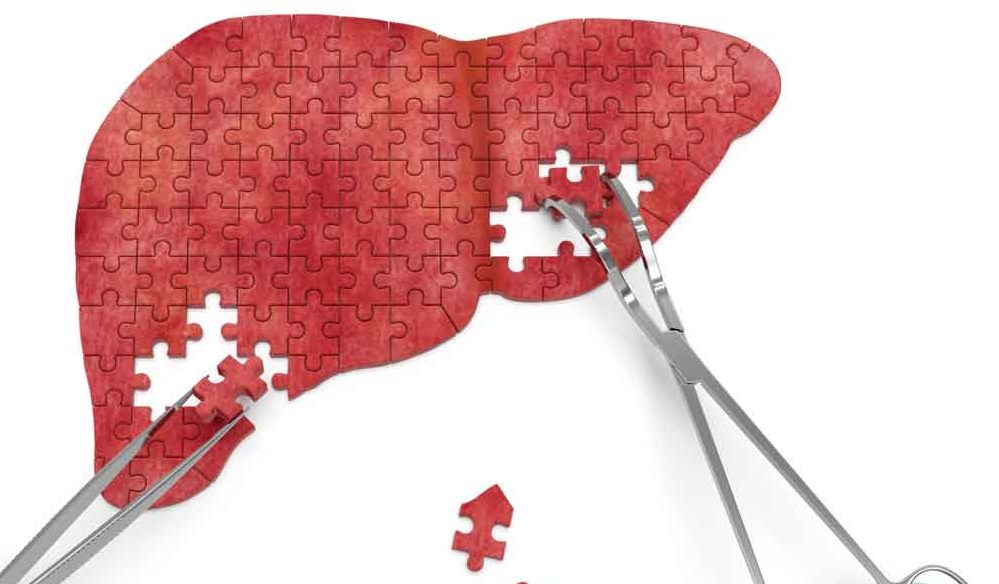 What Is Cirrhosis of the Liver?