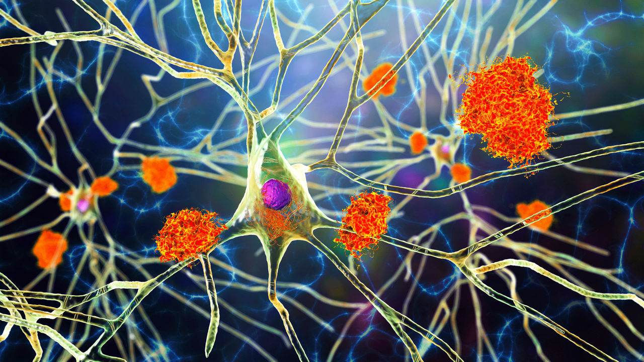 Can Chronic Gum Disease Cause Alzheimer’s? Can Chronic Gum Disease Cause Alzheimer’s?