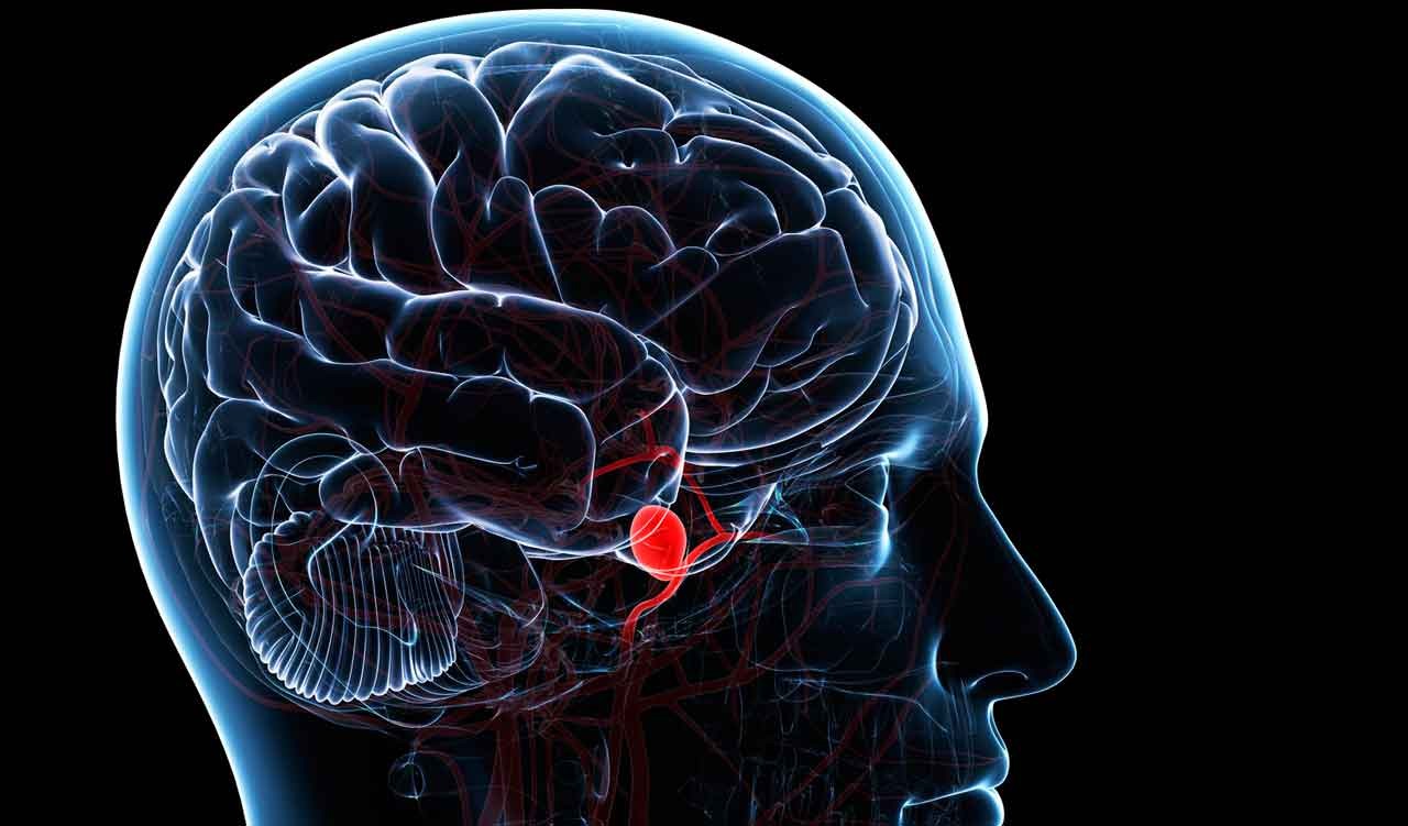 Brain Aneurysm Symptoms