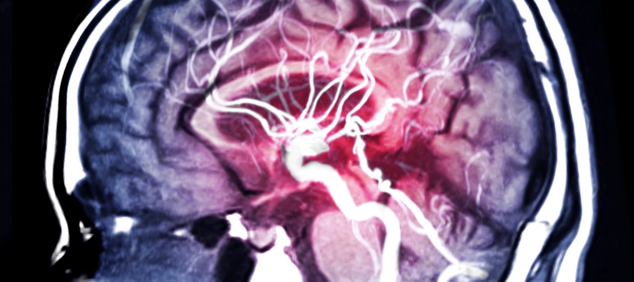 Brain Aneurysm Treatment