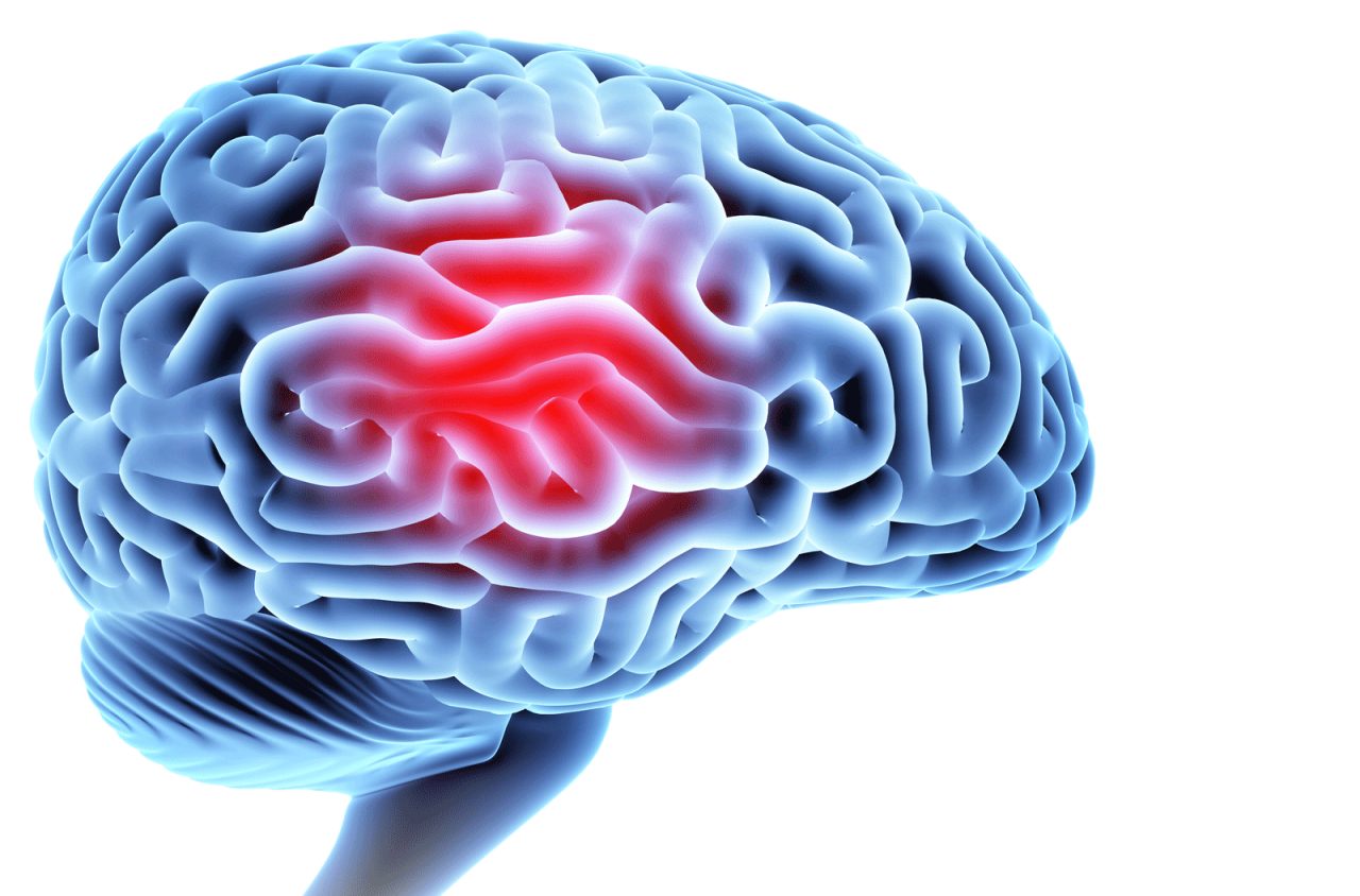 What Is a Hemorrhagic Stroke? What Is a Hemorrhagic Stroke?
