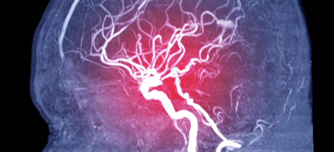 What Is an Aneurysm?
