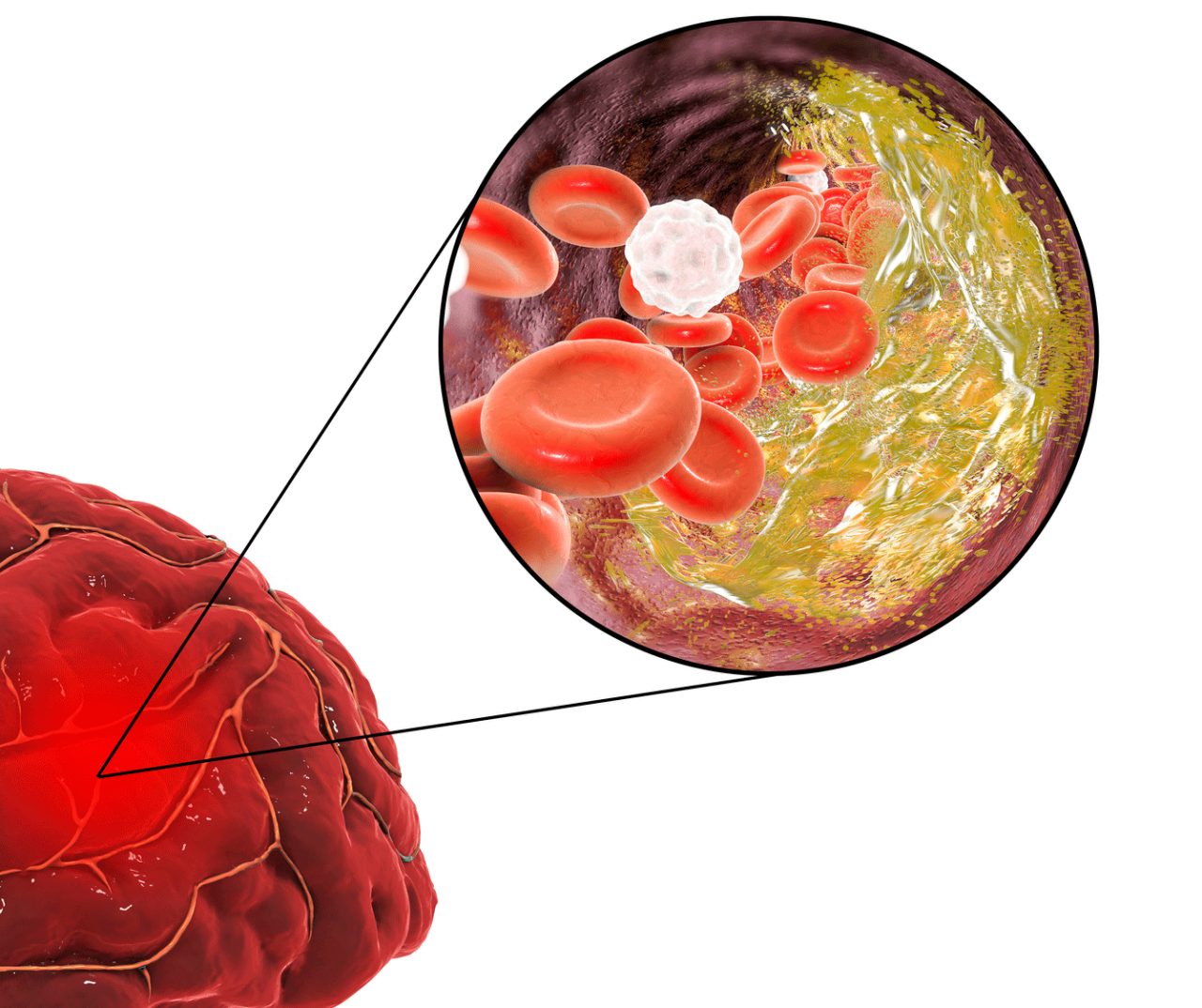 What Is Ischemic Stroke?