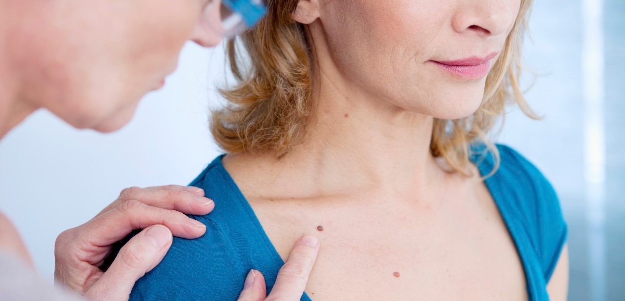 5 Ways to Prevent Skin Cancer 