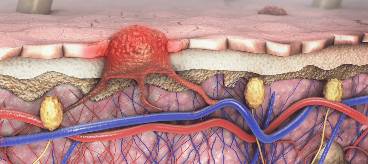 Frequently Asked Questions About Melanoma Frequently Asked Questions About Melanoma
