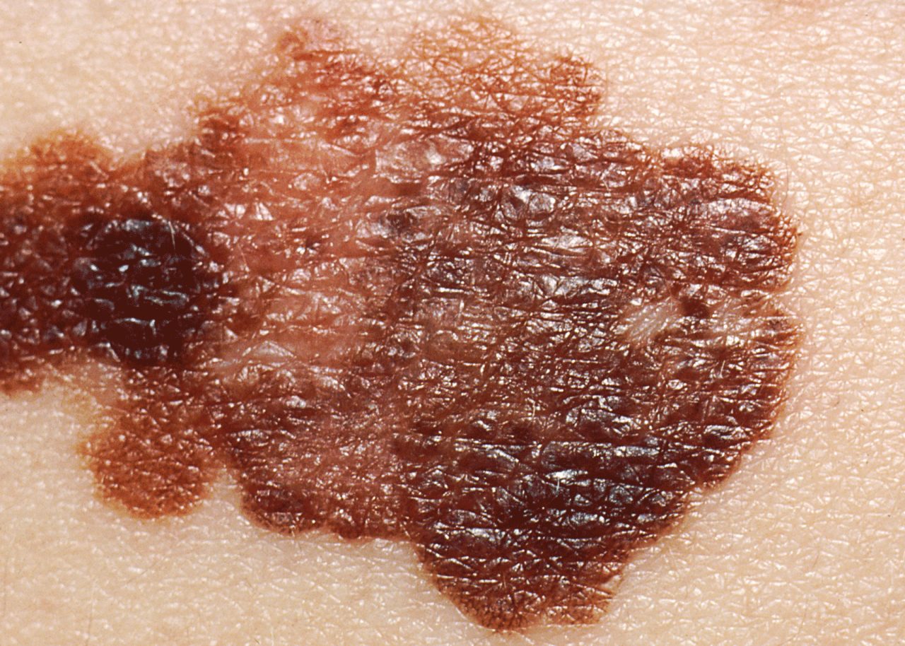 Questions to Ask About Your Melanoma Treatment