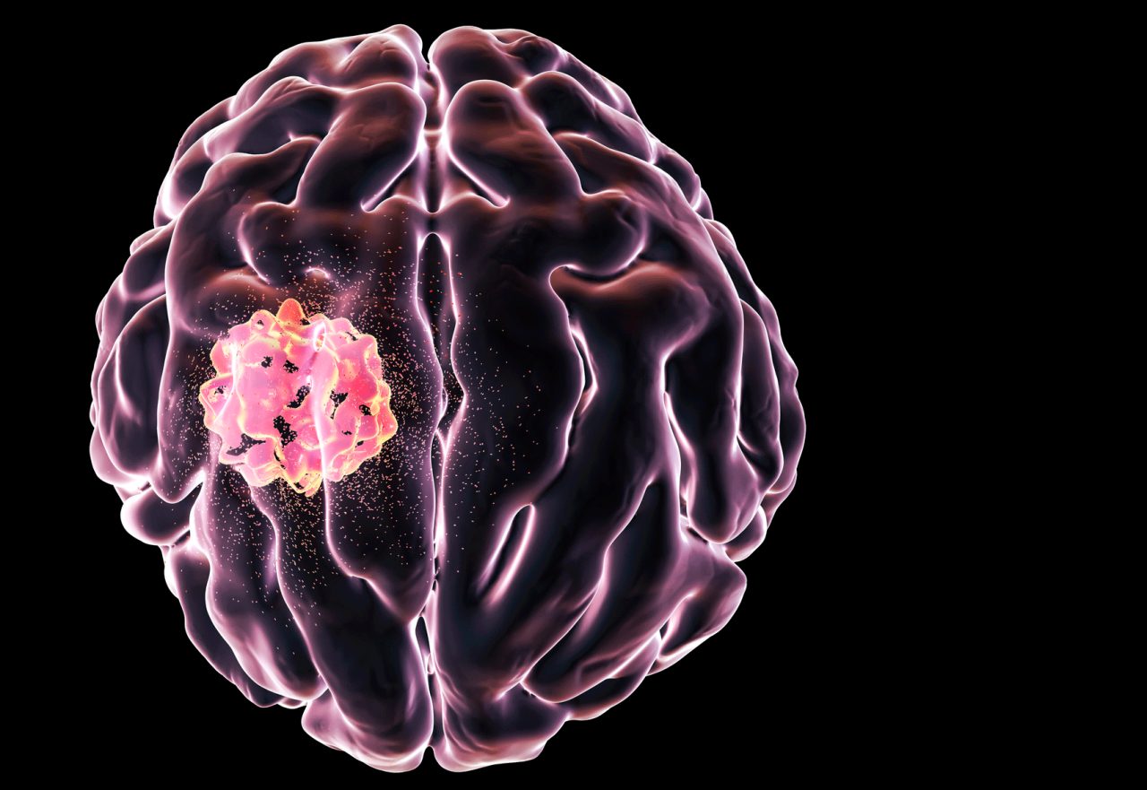 Types Of Brain Tumors Yourcareeverywhere