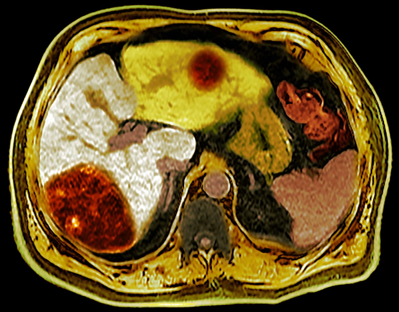 What Is Liver Cancer? What Is Liver Cancer?