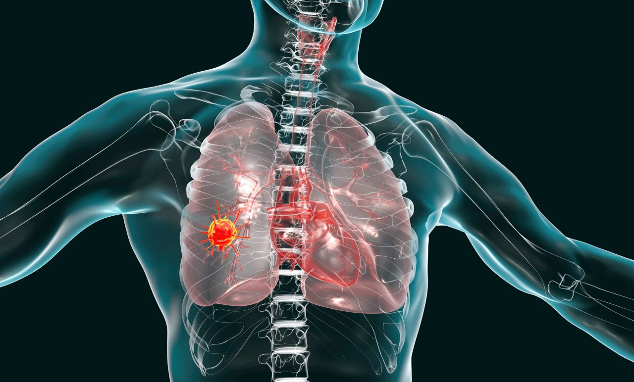 You Can Get Lung Cancer Even If You Never Smoked YourCareEverywhere