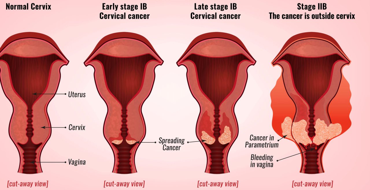 Cervical Cancer Stages