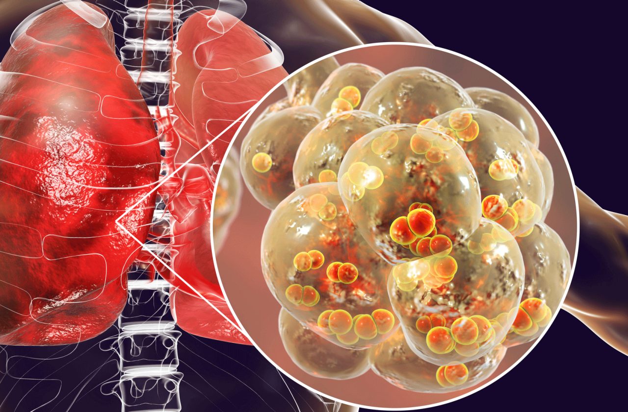 What Is Pneumonia?