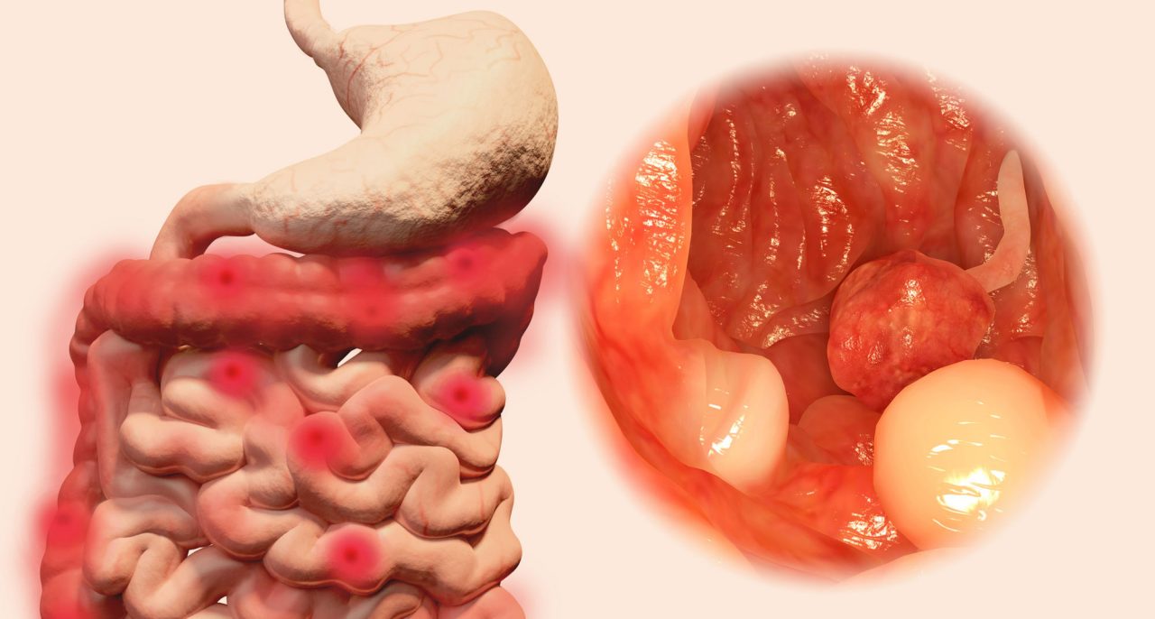 Types of Colon Cancer Types of Colon Cancer