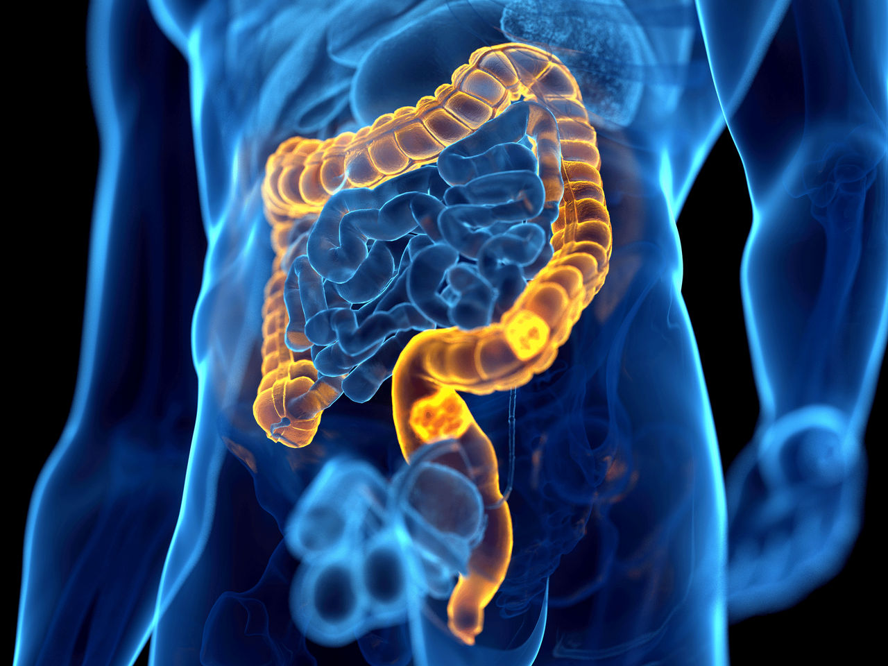 Your Chances for Recovery from Colon (Colorectal) Cancer