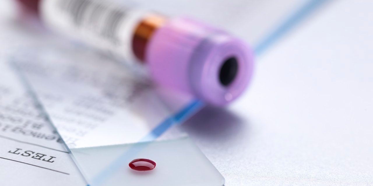 0042-11-30T00:00:00.000Z Blood sample on microscope slide with vial and results of the blood test. --- Image by © Andrew Brookes/Corbis