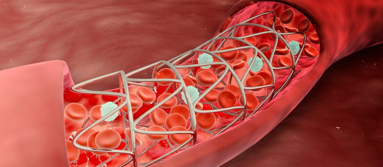13 May 2013 --- Artery cross-section with blood flow and stent deployment. --- Image by © Stocktrek Images/Corbis