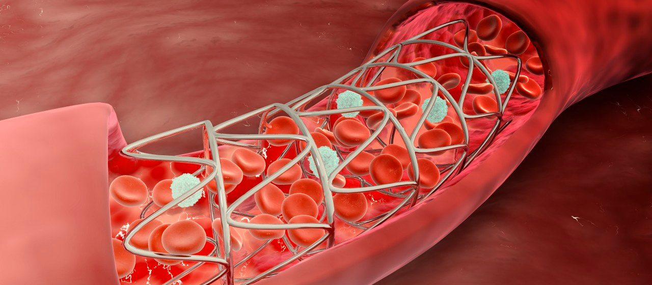 0042-11-30T00:00:00.000Z 13 May 2013 --- Artery cross-section with blood flow and stent deployment. --- Image by © Stocktrek Images/Corbis