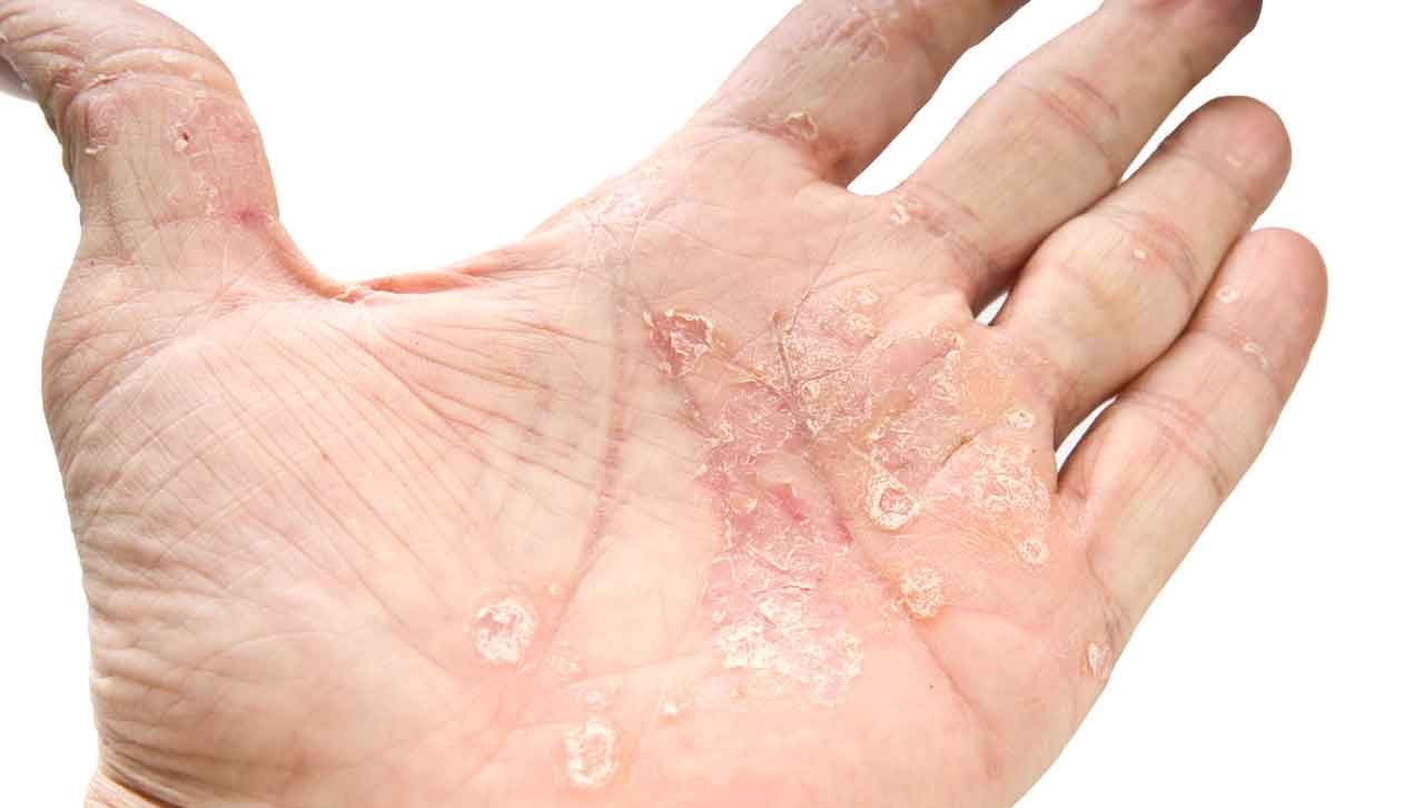 Is there a link Between Psoriasis and Diabetes?
