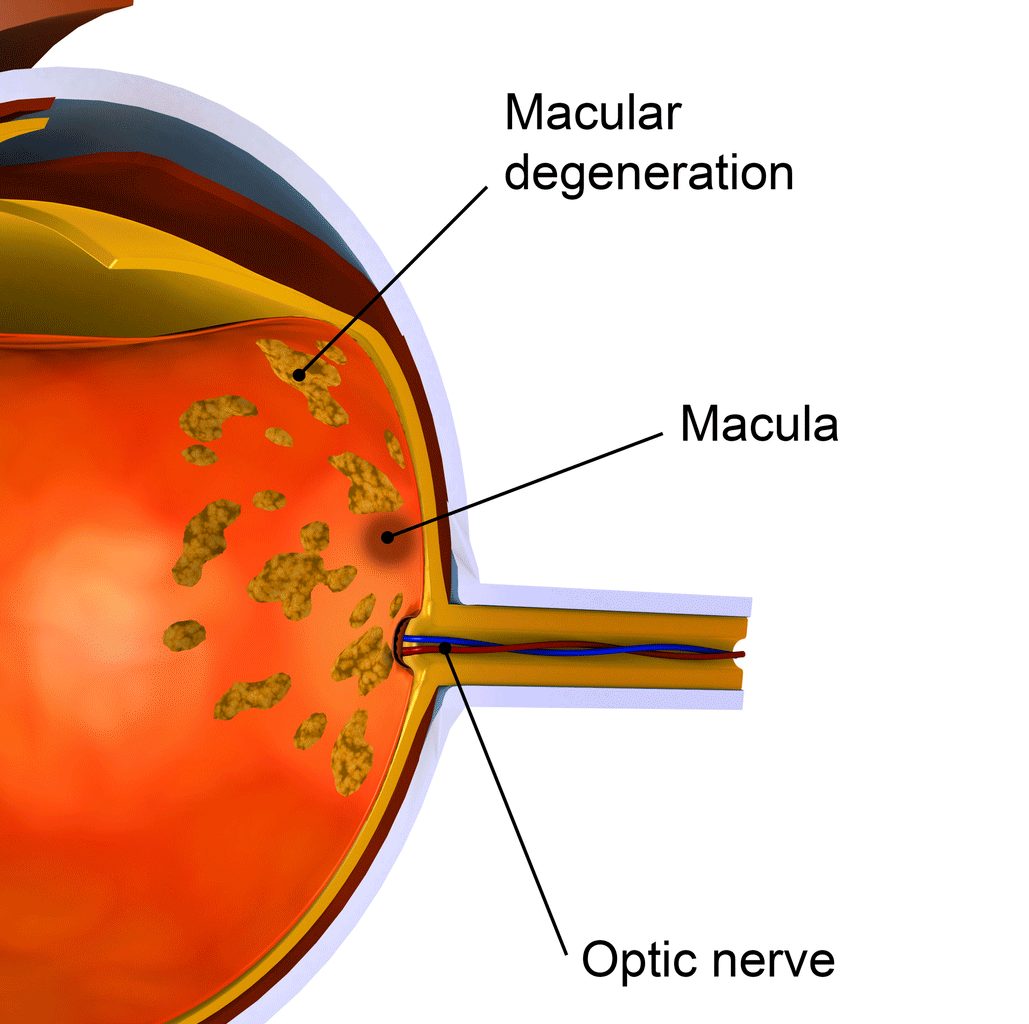 Diet Can Protect You from Macular Degeneration