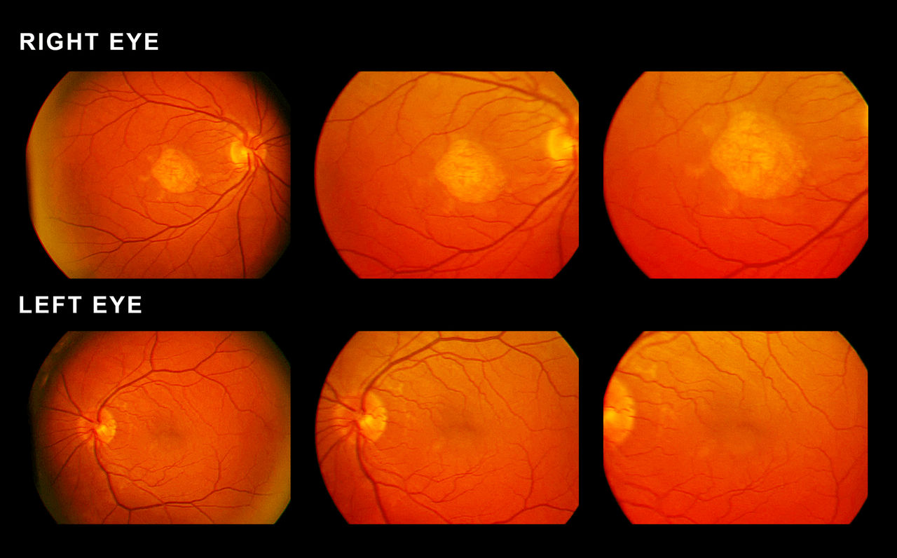 What Is Macular Degeneration?