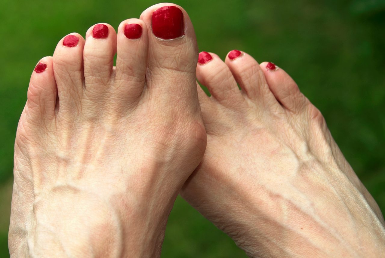 Bunion Causes and Treatments