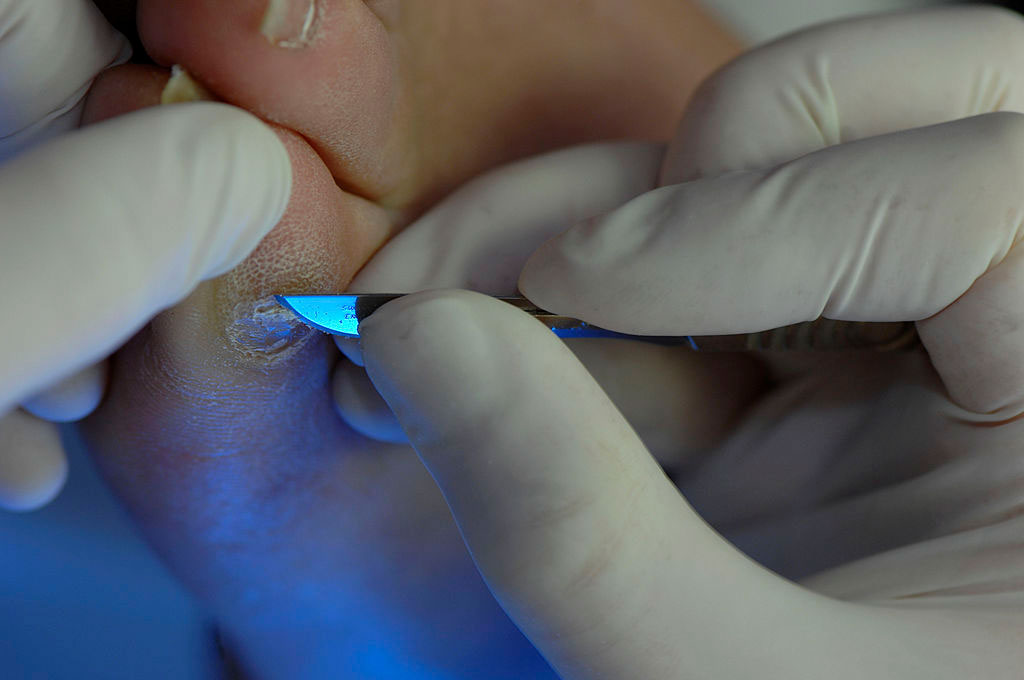 How to Get Rid of Corns and Calluses How to Get Rid of Corns and Calluses