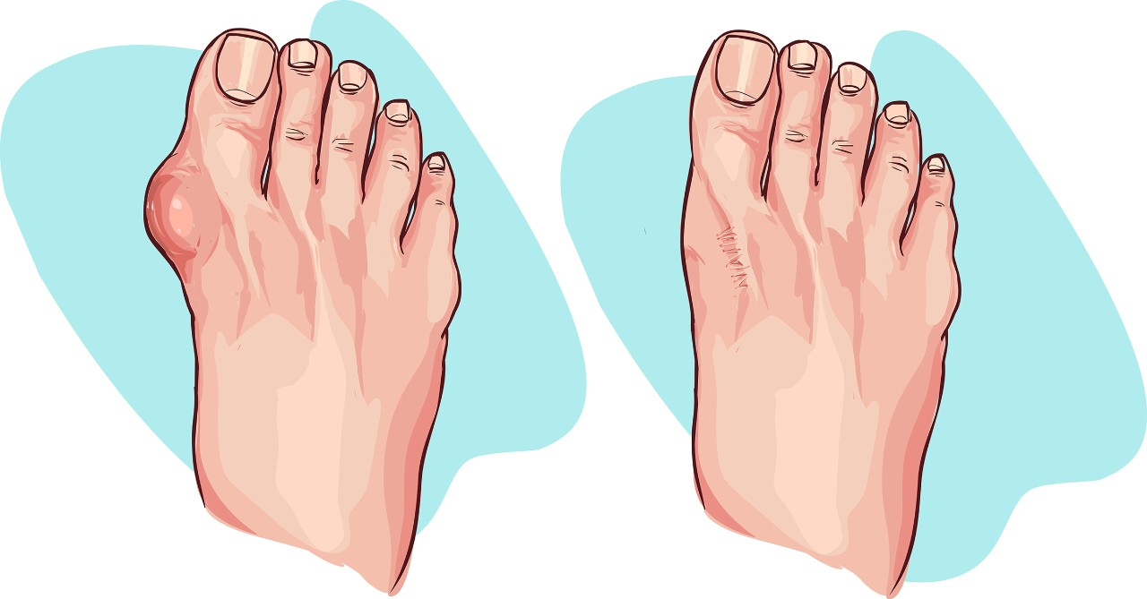 How to Get Rid of Gout