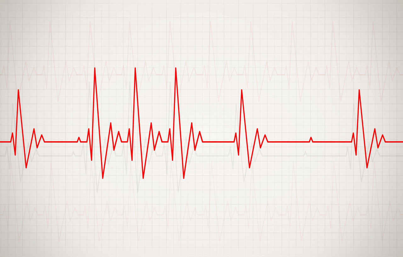 Irregular Heartbeat Symptoms