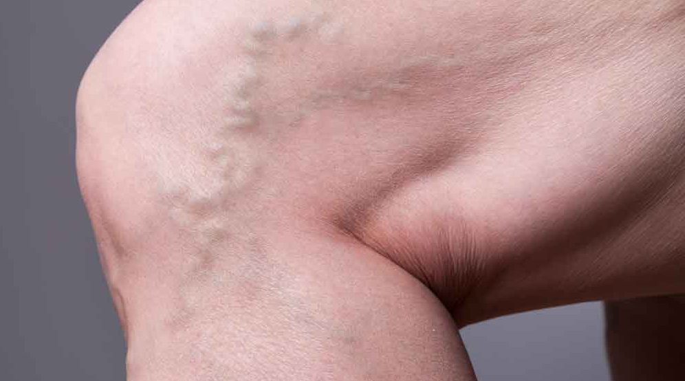 What Causes Varicose Veins?