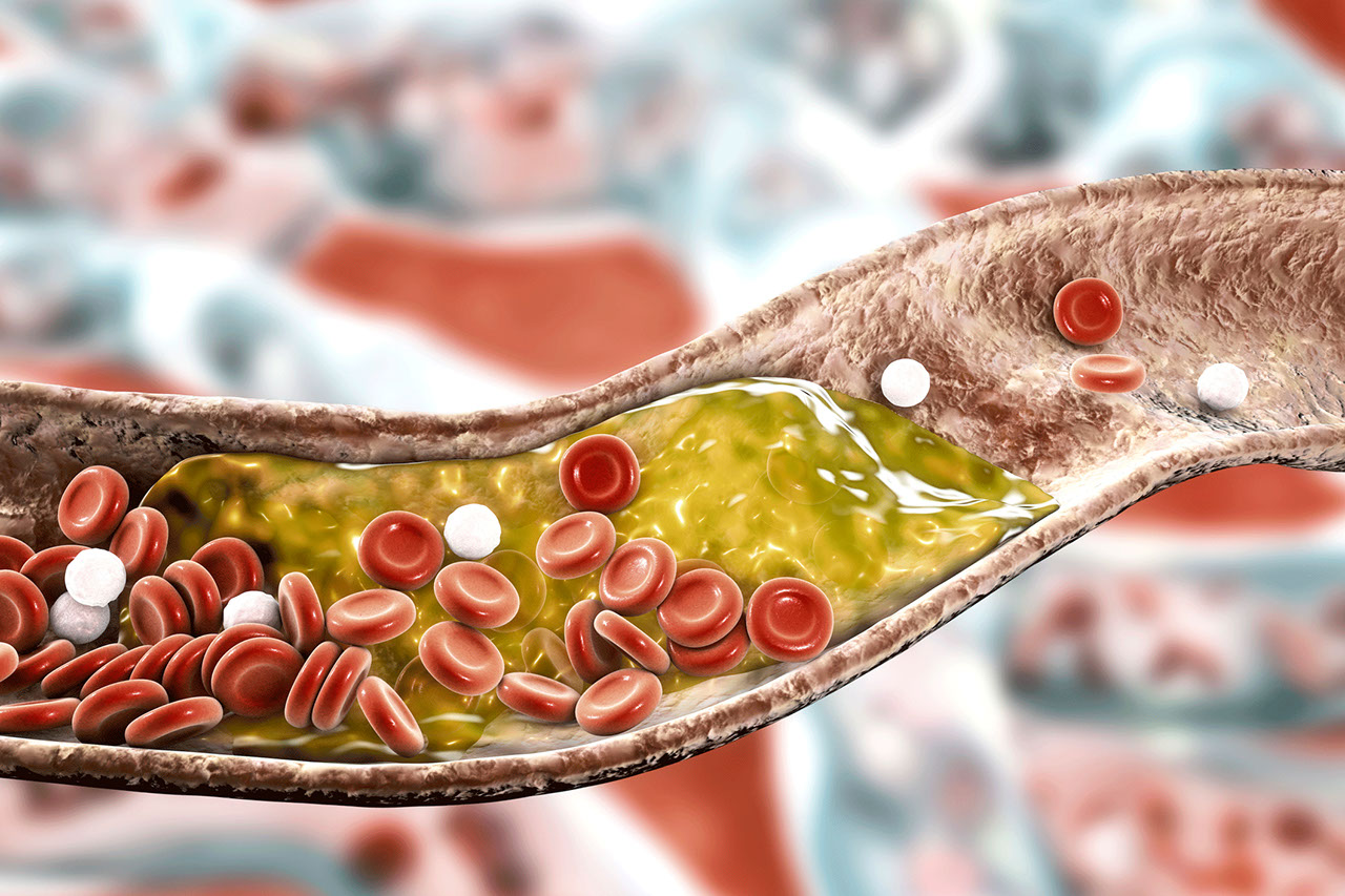 What Is Arteriosclerosis (Atherosclerosis)?