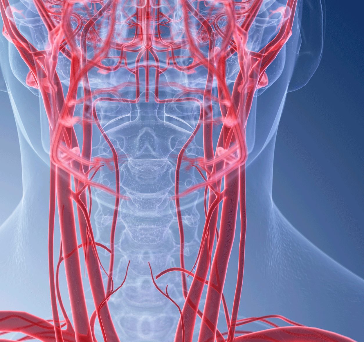 What Is Carotid Artery Disease?