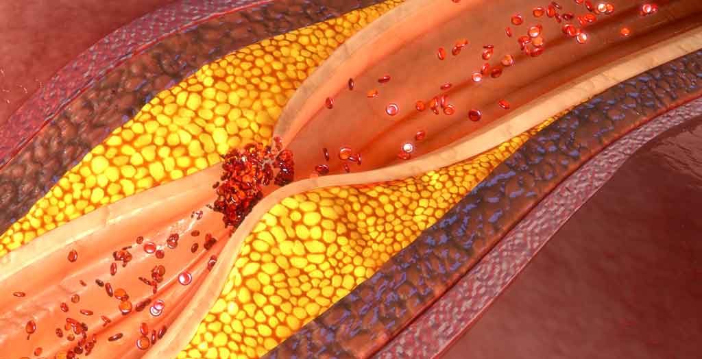 What Is Coronary Artery Disease?