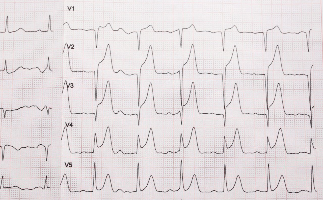 What Is Ventricular Fibrillation?