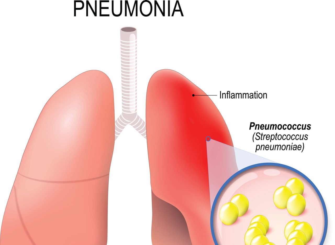 Is Walking Pneumonia Contagious?