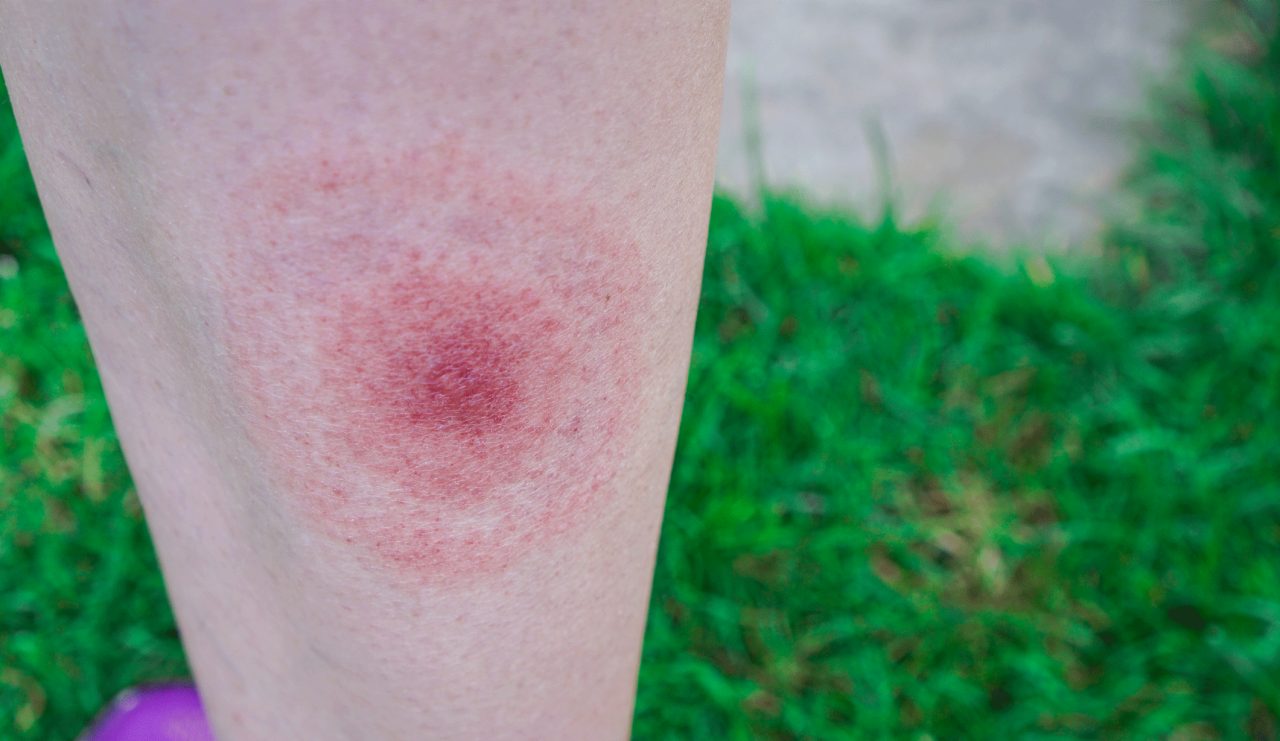 Lyme Disease Controversies Continue