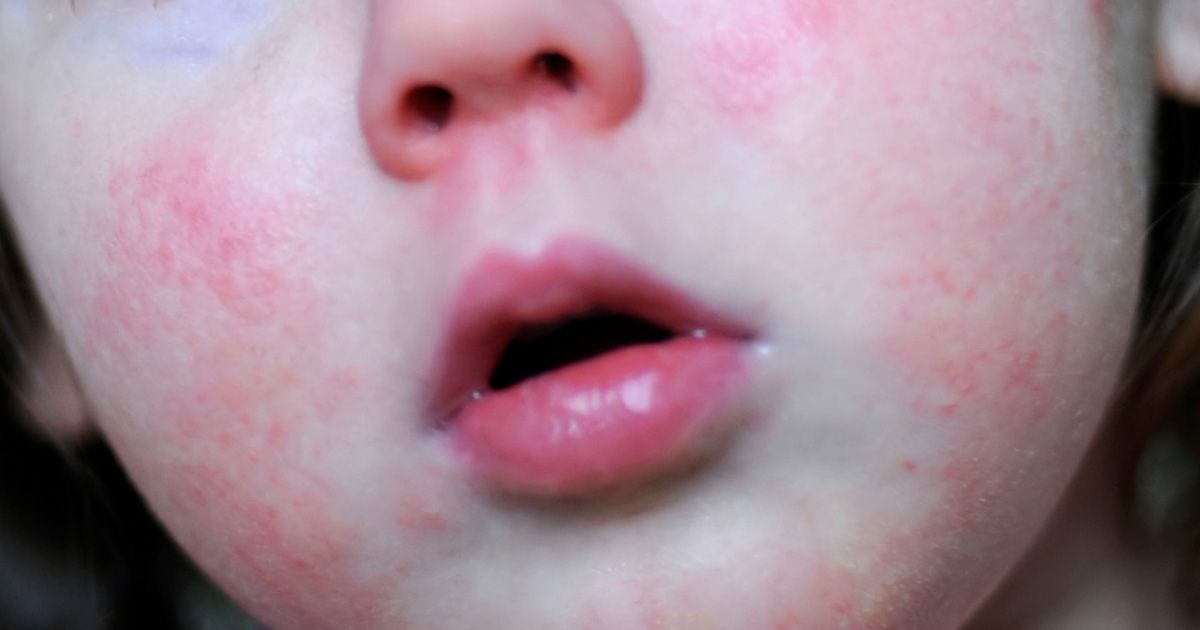 Scarlet Fever Rash Scarlet Fever Rash