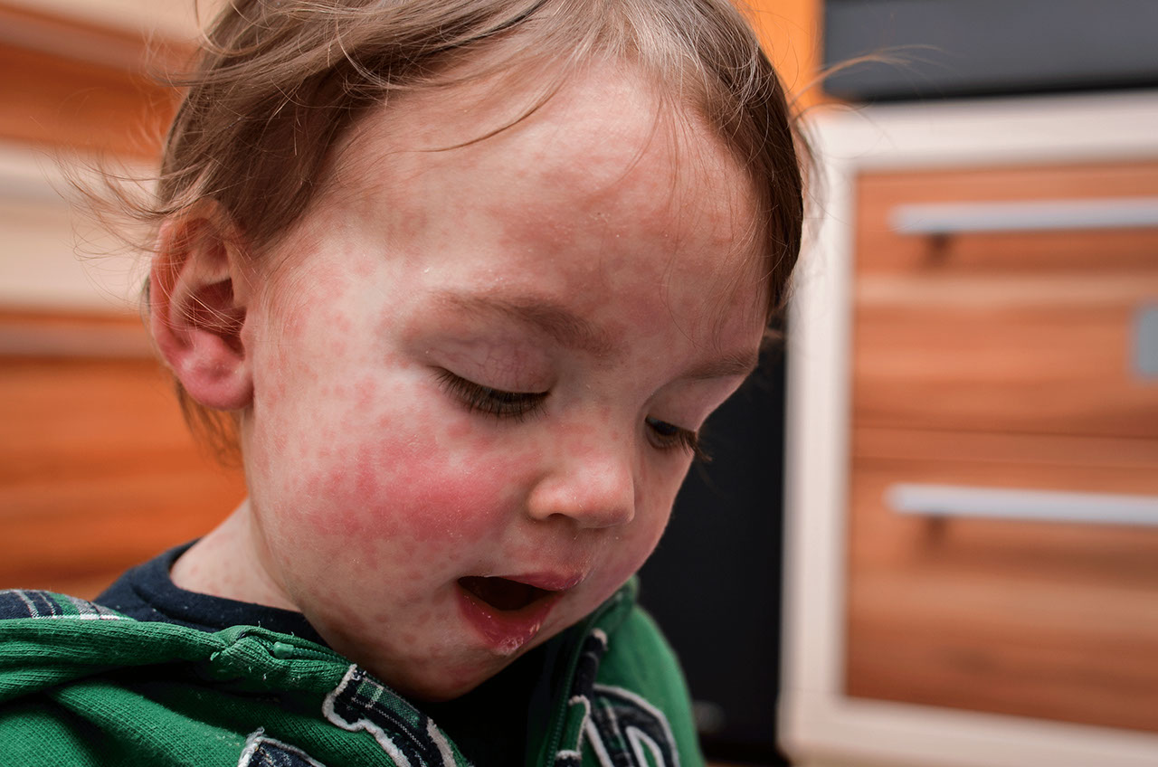 What Are Measles, Mumps, and Rubella?