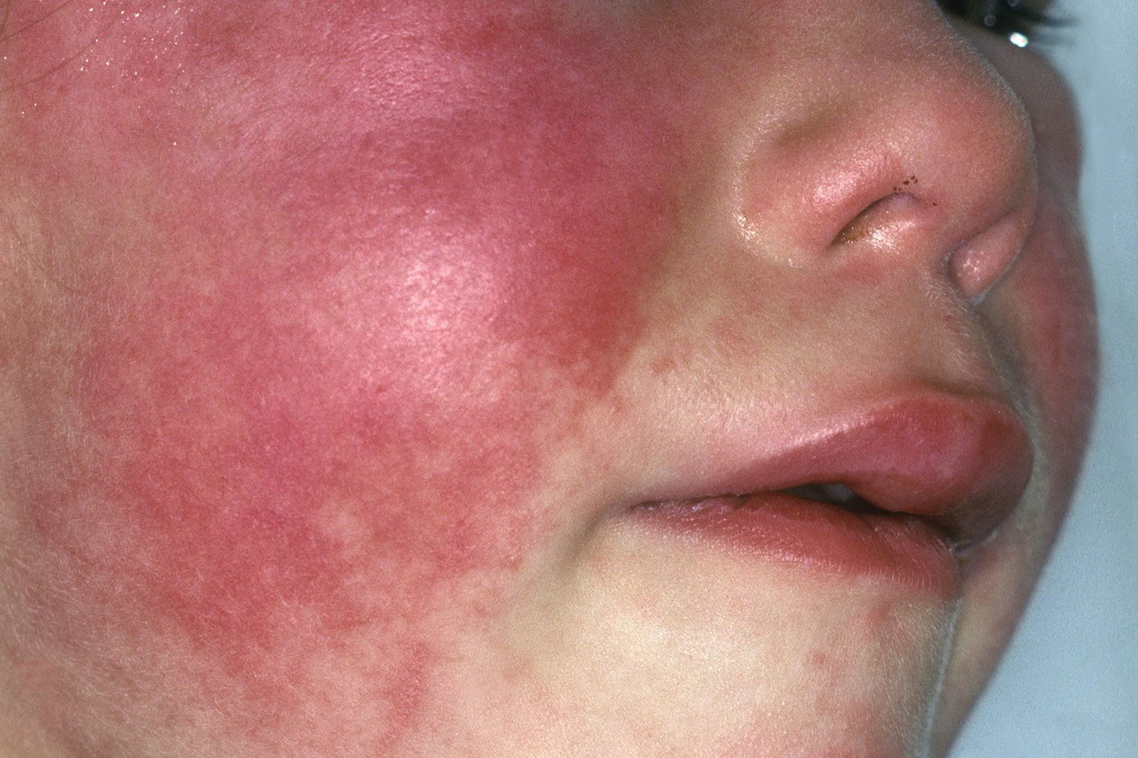 What Is Scarlet Fever?