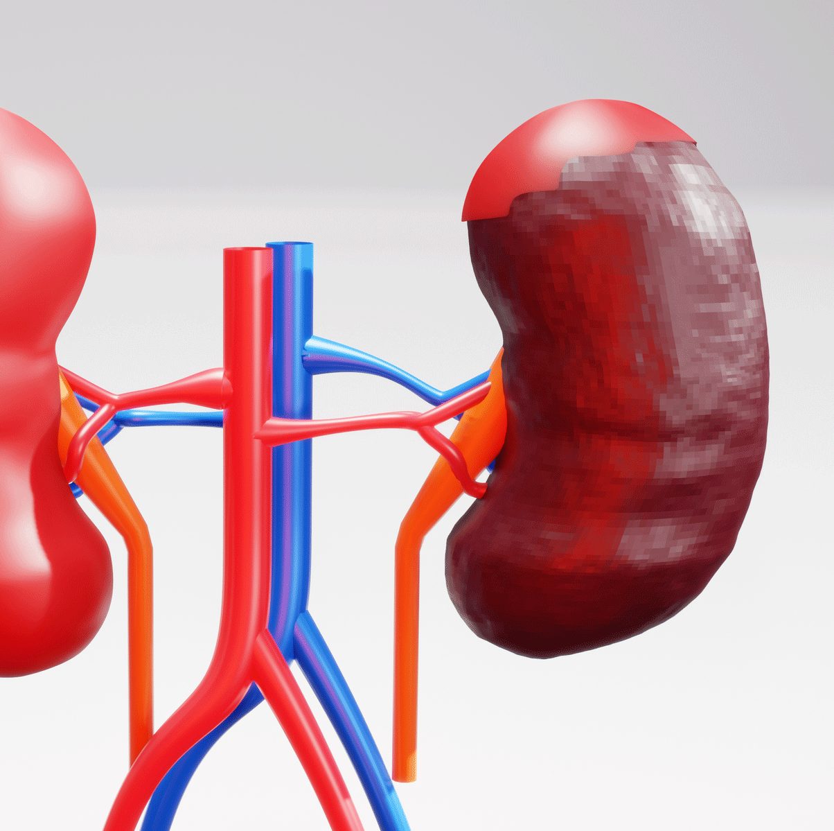 What Is Kidney (Renal) Cancer